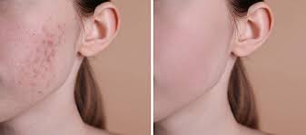 ندبات حب الشباب